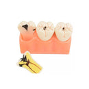 4x Enlarged Dental Caries Decomposition Tooth Model