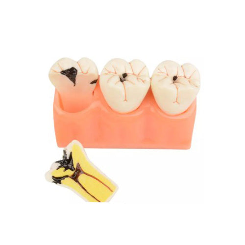 4x Enlarged Dental Caries Decomposition Tooth Model